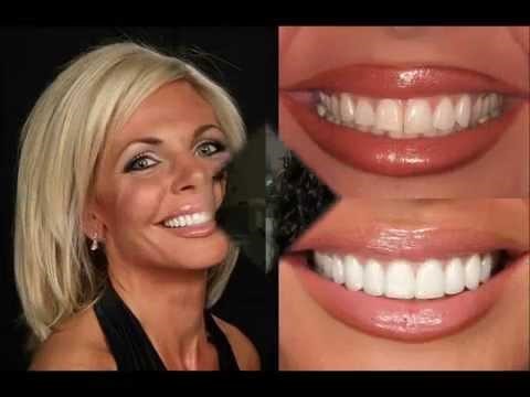 Smile make-overs: what really happens?