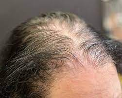 What are the Different Types of Hair Loss?